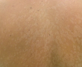 Napgomba-pityriasis-versicolor