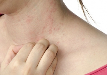 Dermatitis – “koszmó”