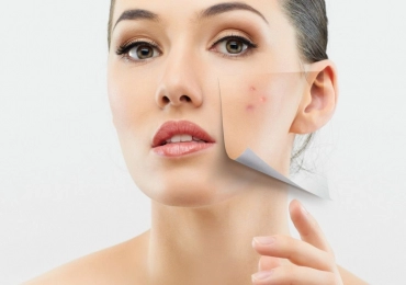 Rosacea