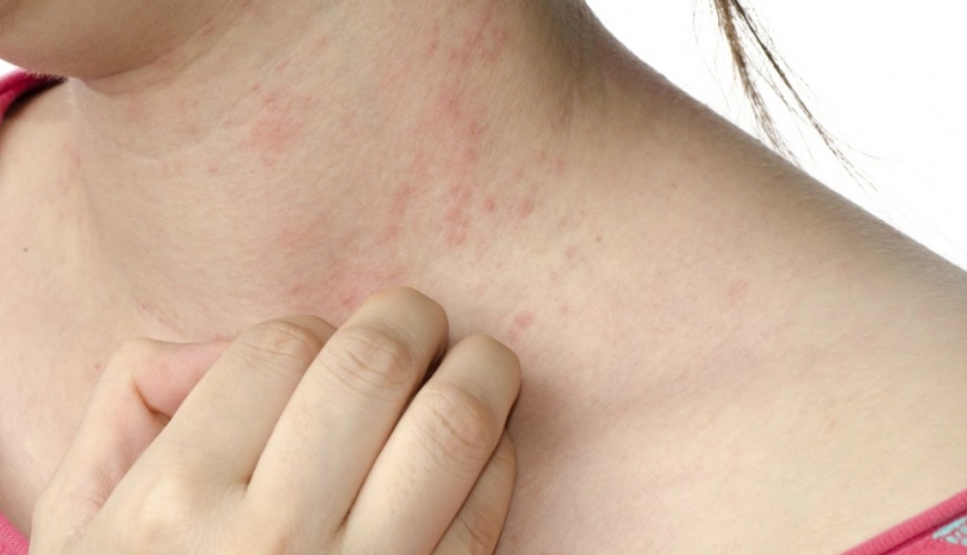 Dermatitis – “koszmó”