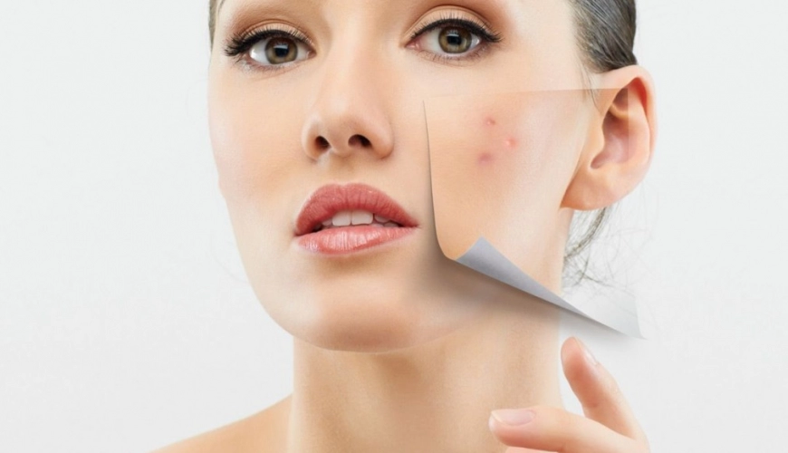 Rosacea