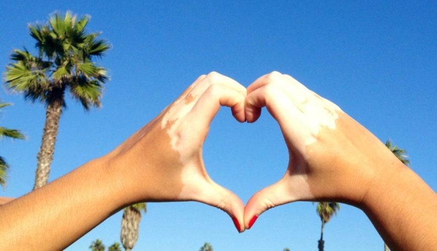 Vitiligo
